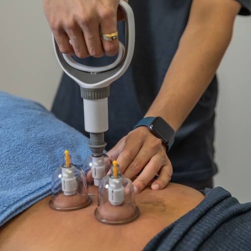 cupping-therapy-hands-of-hope-physical-therapy-Atlanta-GA